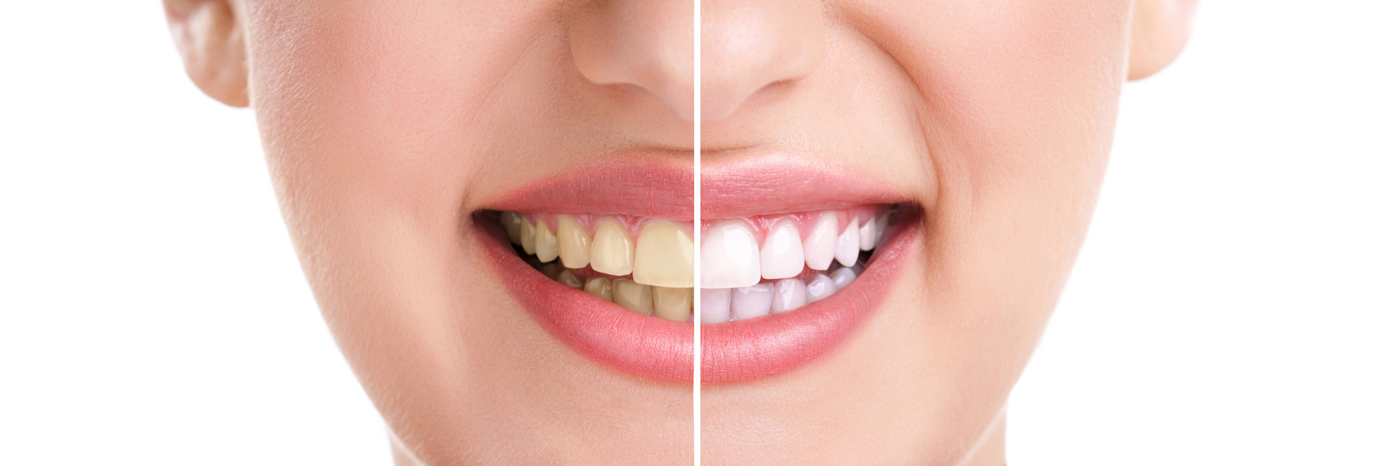 10 Dazzling Benefits of Teeth Whitening