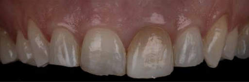 Front-teeth Bonding - Before