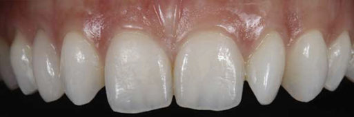Implant Retained Dentures - Before